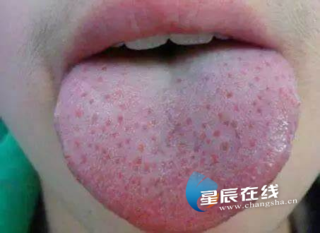 舌:发疹初期,部分孩子舌头上会有一层厚重的白苔,舌乳头红肿,形似草莓