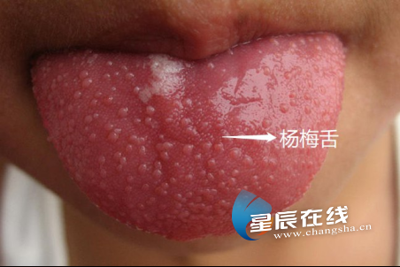 健康科普 | 分清猩红热与疱疹性咽峡炎 对症下药才有效